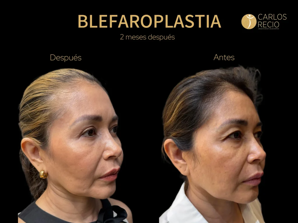Blefaroplastia en Cali: precio y cómo rejuvenecer la mirada con el Dr. Carlos Recio Blefaroplastia en Cali: precio y cómo rejuvenecer la mirada con el Dr. Carlos Recio